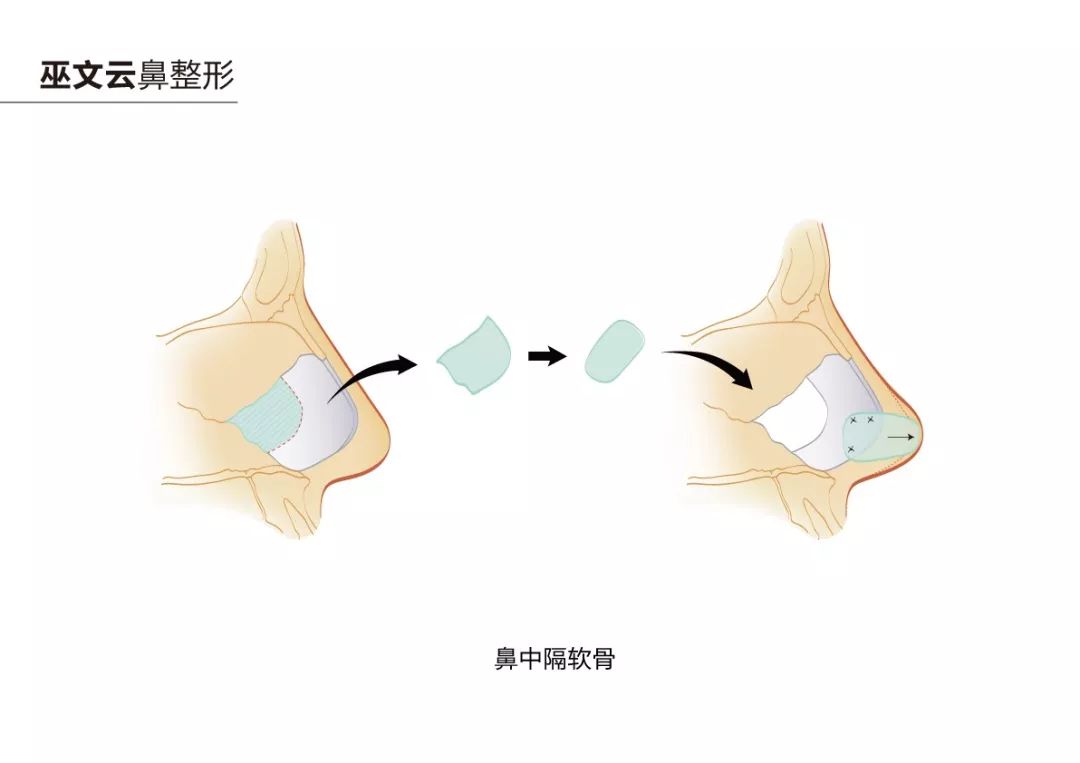 那么要如何保证既要取出大而完整的鼻中隔软骨,又不破坏原来的支撑力