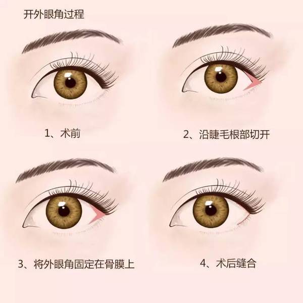 眼角主要影响内眼角处双眼皮的形成分为轻,中,重度内眦赘皮是眼角的一