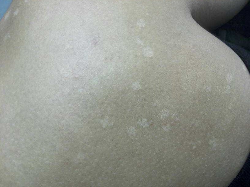 四,背上皮肤有白斑可能是花斑癣:花斑糠疹,旧称花斑癣,俗称汗斑,是