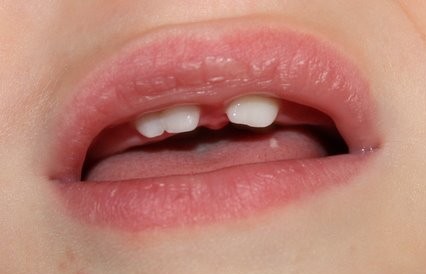 双牙畸形双生牙与融合牙