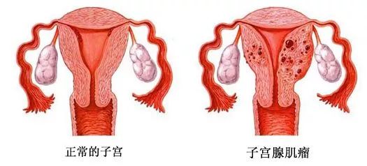 子宫腺肌症会影响生育吗能治好吗北京卫人医院程亚辉说