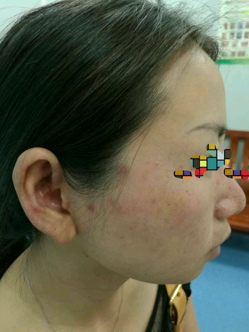 被误做皮炎的红斑狼疮 上病例: 患者女性,面部皮疹5年,偶尔瘙痒,曾拟