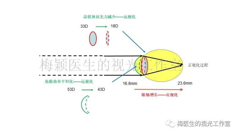 在眼球的发育过程中,角膜曲率会逐渐变平坦(从出生时的51.2d到成人43.