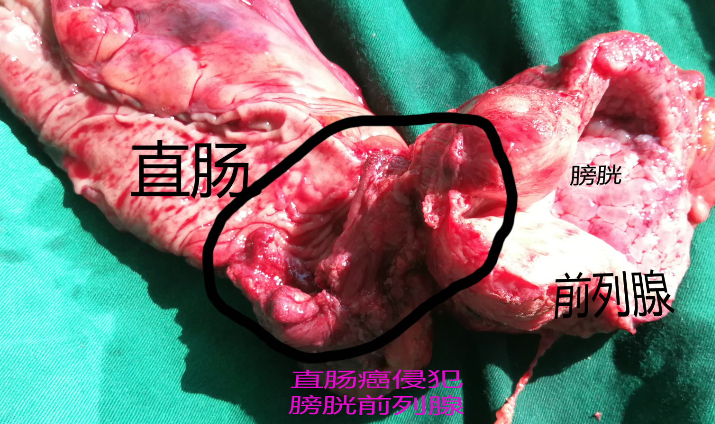 晚期肠癌全盆腔脏器切除及肝脏肿瘤切除