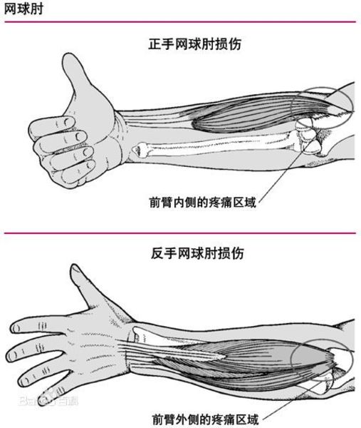伸肌腱牵拉试验(mills征):肘伸直,握拳,屈腕.