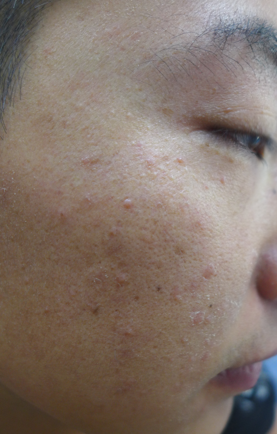 点状丘疹伴痒是病毒性皮疹的表现