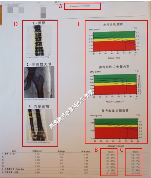 骨密度(bmd)检测仍然是目前医学上评估人体骨骼质量,判定是否存在骨质