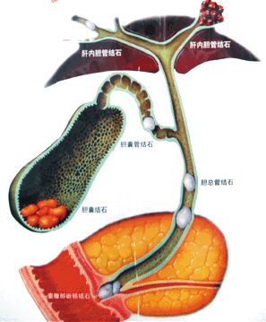 危害一,腹痛和饮食下降:结石致胆总管梗阻引起上腹疼痛甚至阵发**痛