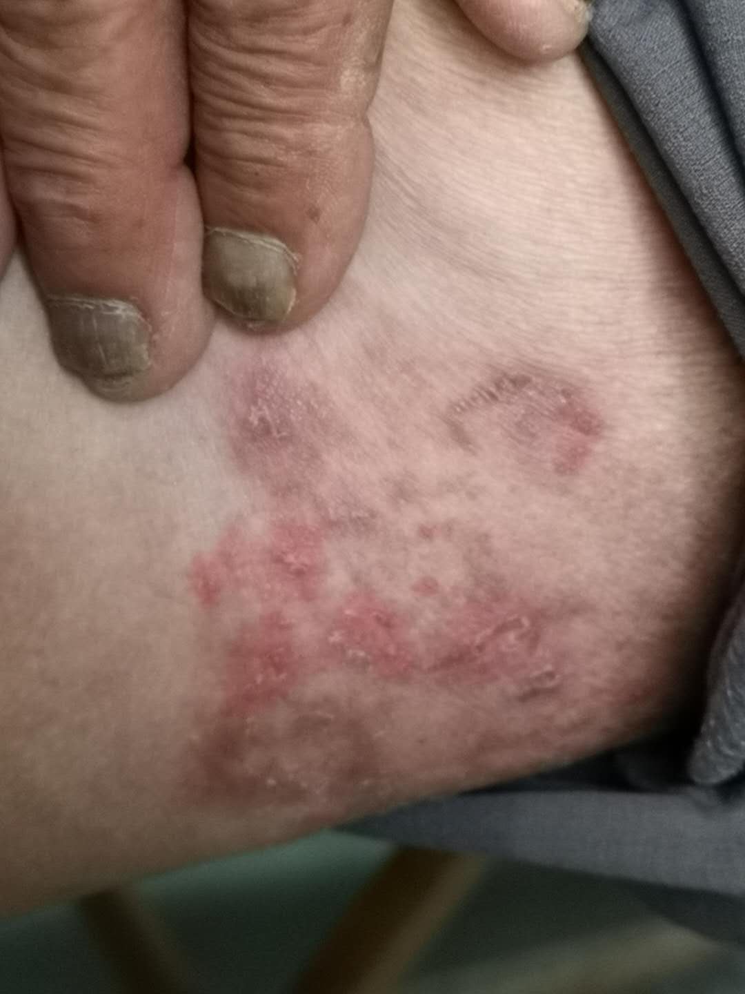 如果原来有足癣(脚气),手癣,股癣等其他部位真菌感染,也要一起治疗