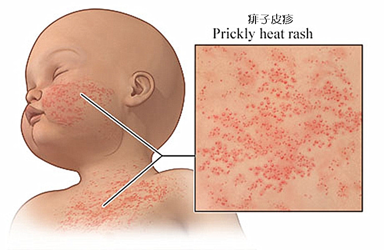 辟谣夏天宝宝长痱子用痱子粉2个方法预防应对