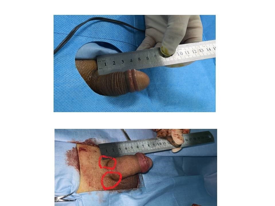 下图给大家展示的是:局部麻醉下的阴茎延长手术,术后成功延长2cm,且