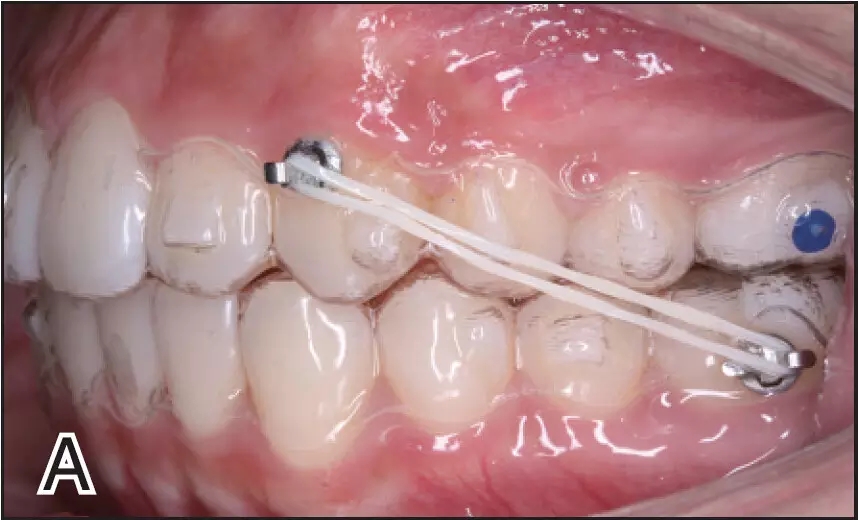 a:无托槽矫治系统中的Ⅱ类颌间牵引,左上第一磨牙区可见蓝色的