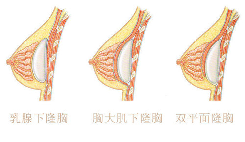 何种大的填充物等等多种元素结合而成,假体植入位置以乳腺下,胸大肌下