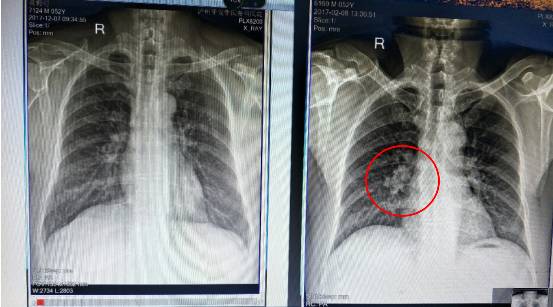 因咳喘,反复感冒等症状来查: