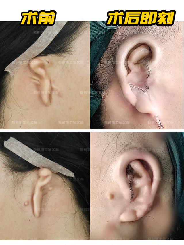 先天性小耳畸形分为这三种