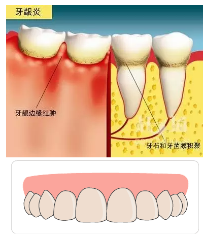 包括仅累及牙龈组织的牙龈病和波及深层牙周组织(牙周膜,牙槽骨,牙