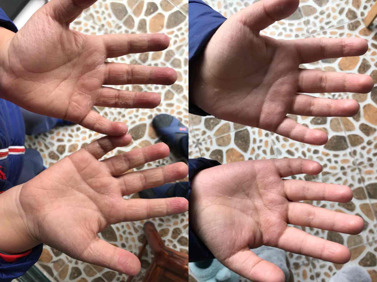 手癣是发生于掌面的真菌病俗称鹅掌疯