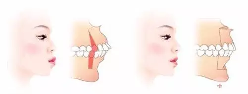 这种骨性问题的凸嘴,就得靠正颌手术矫正了,这种情况下,牙齿矫正就算
