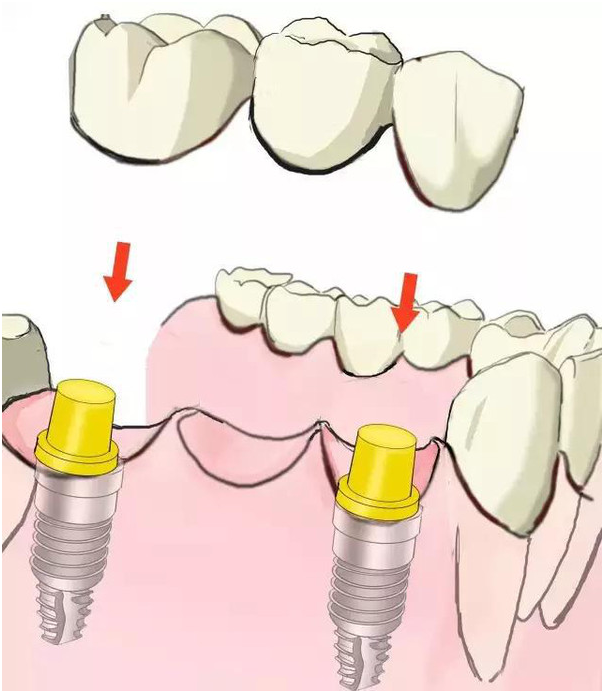 【图文科普】镶牙和种牙的区别!