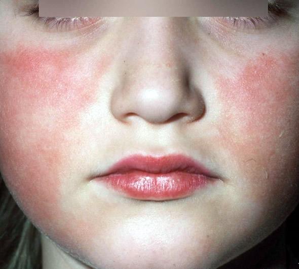 可有典型的面颊红斑疹(即所谓的掌掴面颊疹),并伴相对的口周苍白圈