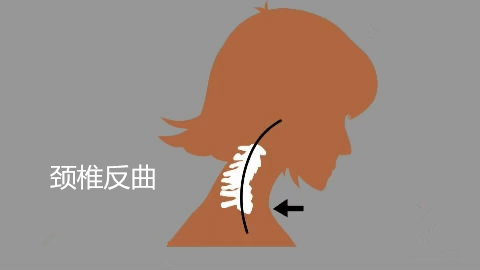 颈椎反曲是颈椎病吗应该怎么办