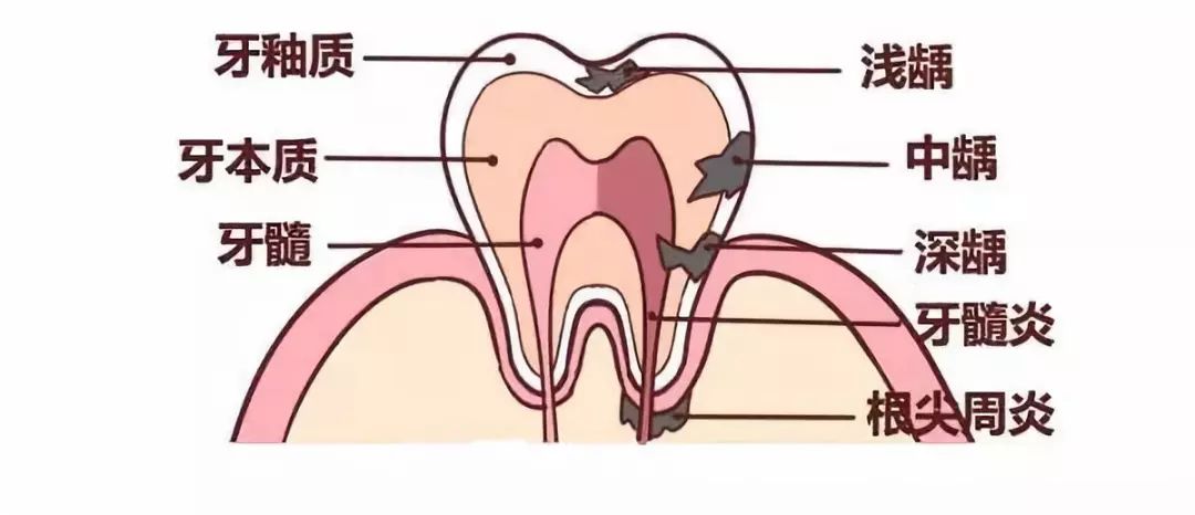 虫牙的学名——龋齿 虫牙的牙齿结构遭到了破坏