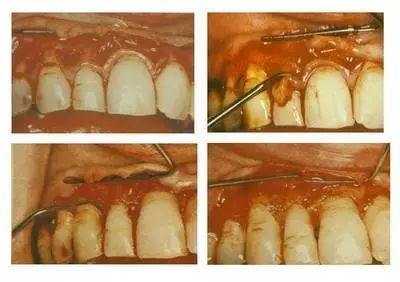 说起不影响生命但影响生活的病,牙周炎首当其冲!