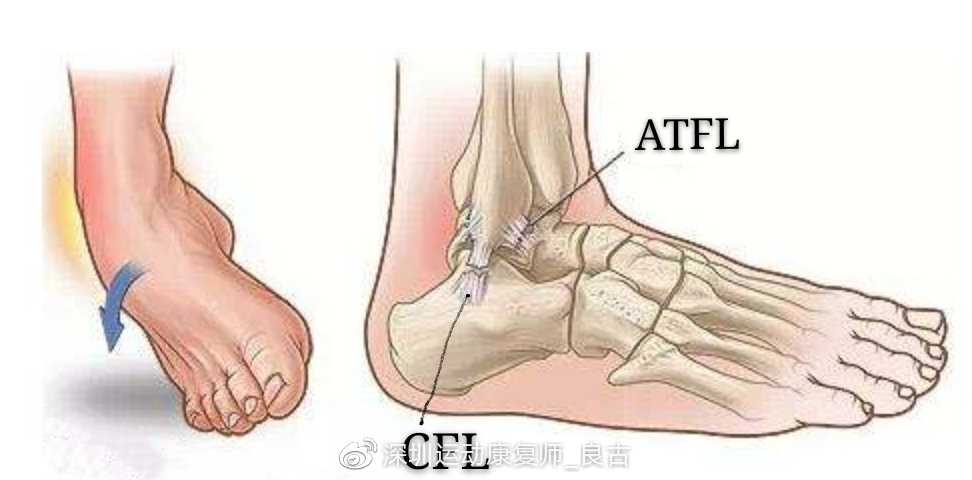 "踝扭伤"的医学生物力学原理