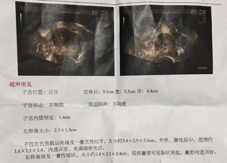 超声提示子宫角部有囊性结节