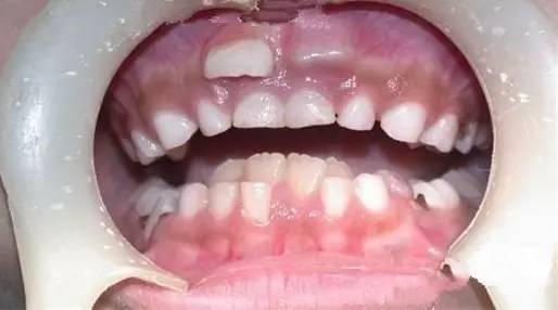 在解释双排牙之前,我们先看一张图片