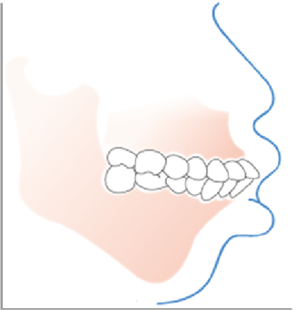 前牙或后牙在垂直方向上下不能咬合 上下前牙
