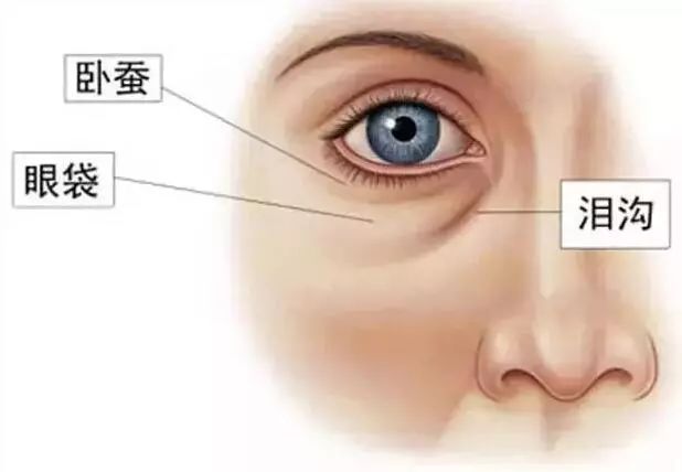 因为跟眼袋类似的有个东西叫做—— 泪沟!