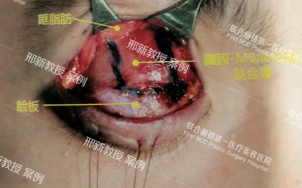 上睑提肌腱膜推进法上脸下垂矫正术及案例