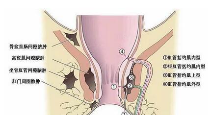 什么是肛周脓肿?