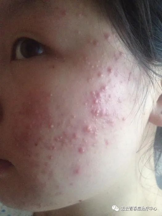 面部的闭合性粉刺和粟丘疹怎么区分?
