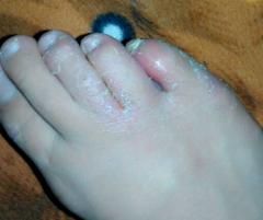 怎样才能治好脚癣 167932_240.jpg