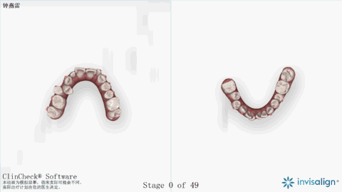 隐适美让你的笑容变得更美