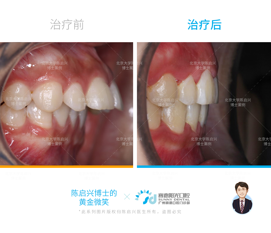 Ⅲ度深覆盖,Ⅱ度深覆合嘴突矫正案例