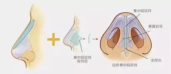 鼻中隔软骨综合鼻整形