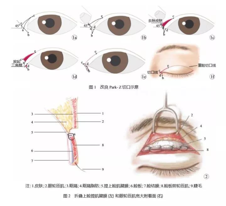 以下开眼角是采用改良park-z法,疤痕也可以说是非常隐蔽了: 开眼角