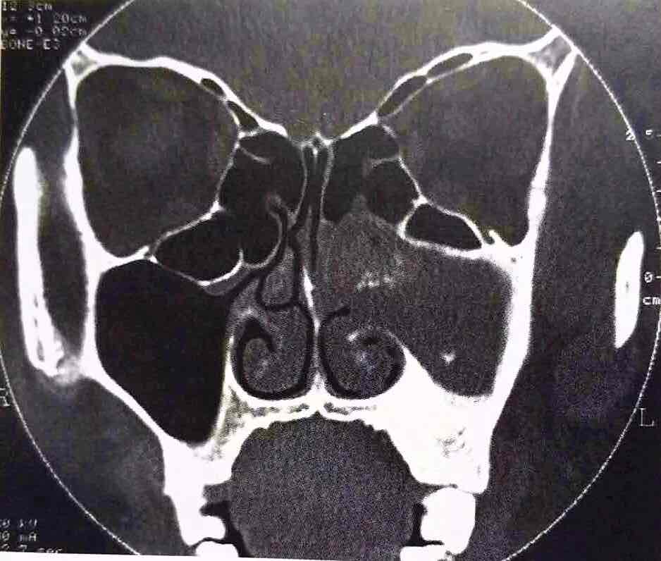 冠状位ct,左侧上颌窦软组织影,密度不均匀,近中鼻道处高密度钙化斑.
