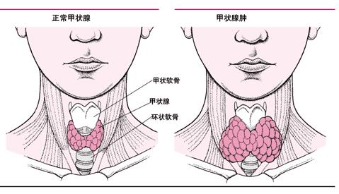 什么是桥本甲状腺炎对人身体有哪些危害