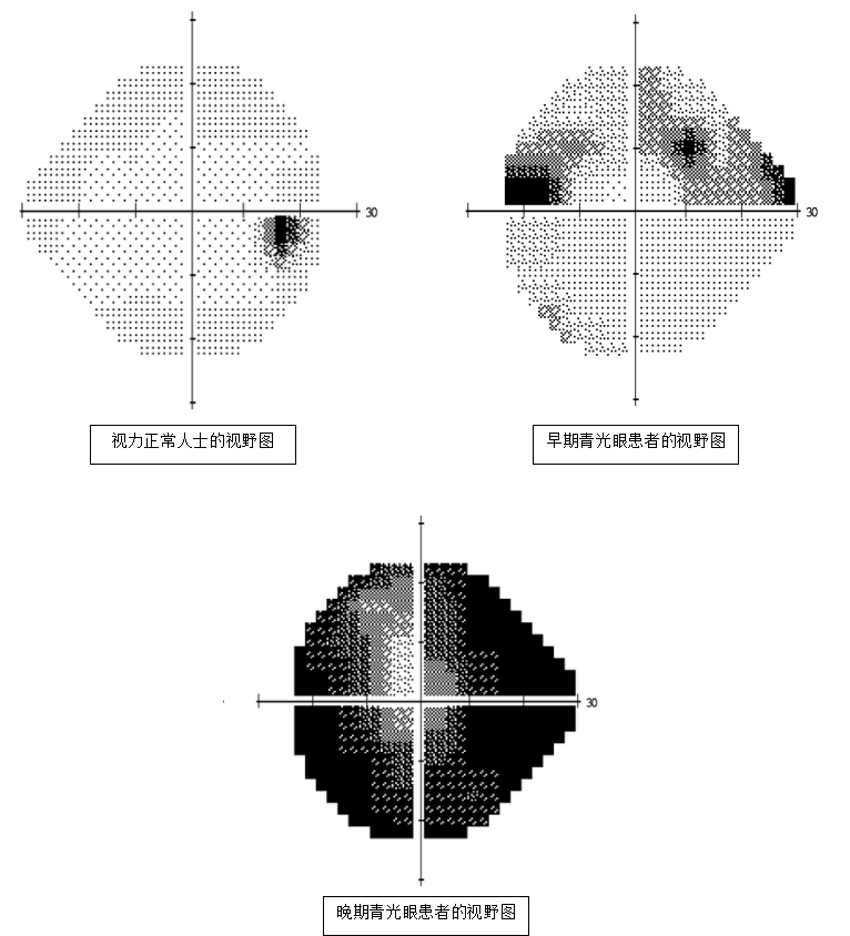 眼压高低已经不是衡量青光眼唯一的标准很多人还不知道