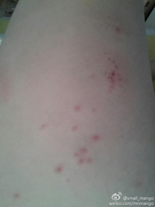最近大腿出了些这种疹子,快痒死了.谁能告诉我这是荨麻疹吗?