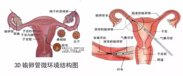 不孕患者福利:输卵管造影术,实现您的"妈妈梦"