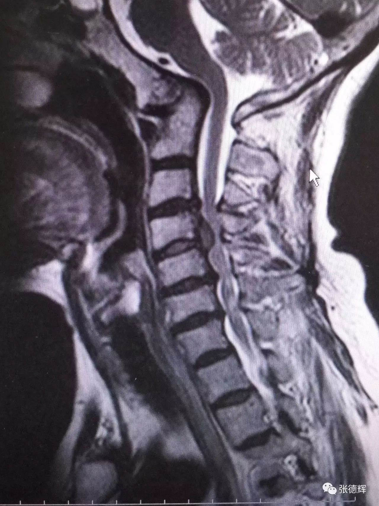 诊断 1,脊髓型颈椎病(颈4-5 椎间盘脱出;2,寰枕融合,颅底凹陷畸形