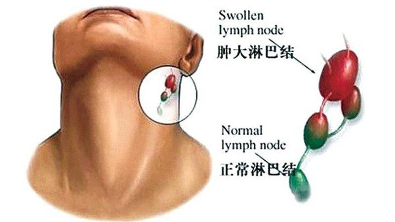 怎样鉴别宝宝淋巴结有没有炎症-杨硕-爱问医生