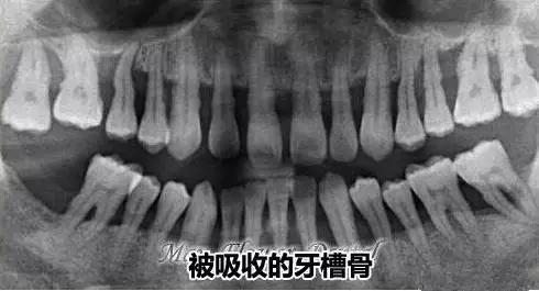 健康的牙槽骨 pk 牙槽骨被吸收