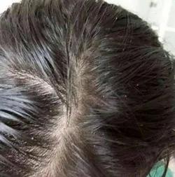 这几个常见的症状就是脂溢性脱发!