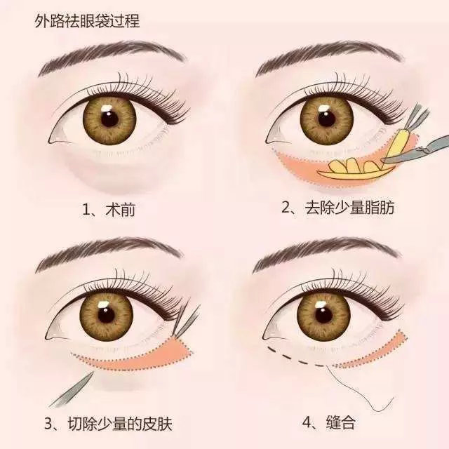 张宗学外切去眼袋手术示意图